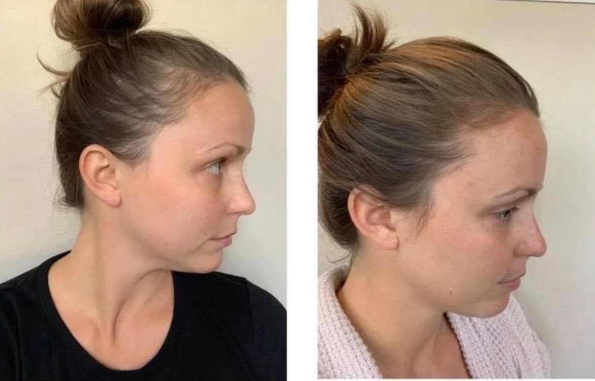 Before and after result 11 — Liquid BioCell user