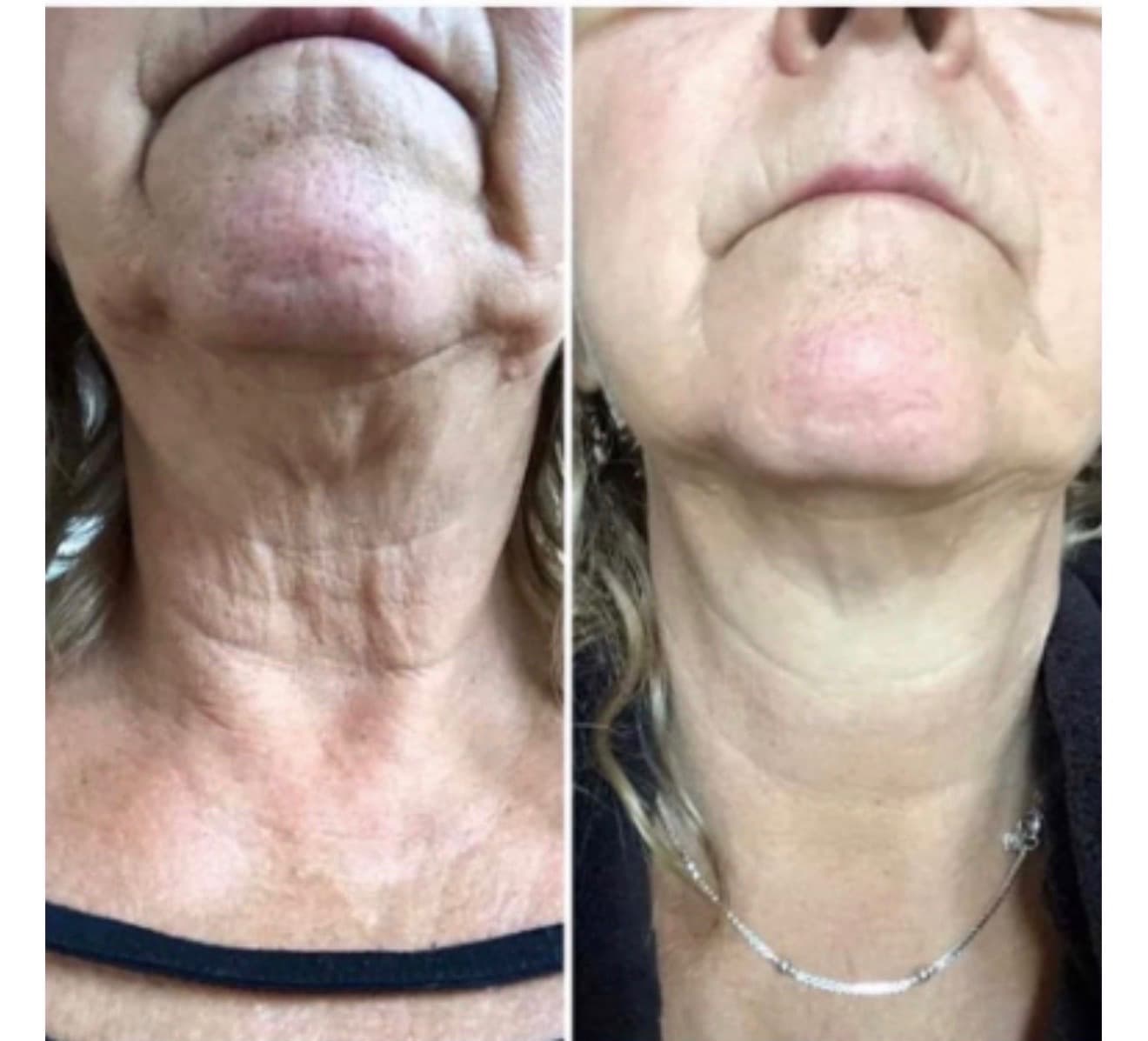 Before and after result 12 — Liquid BioCell user