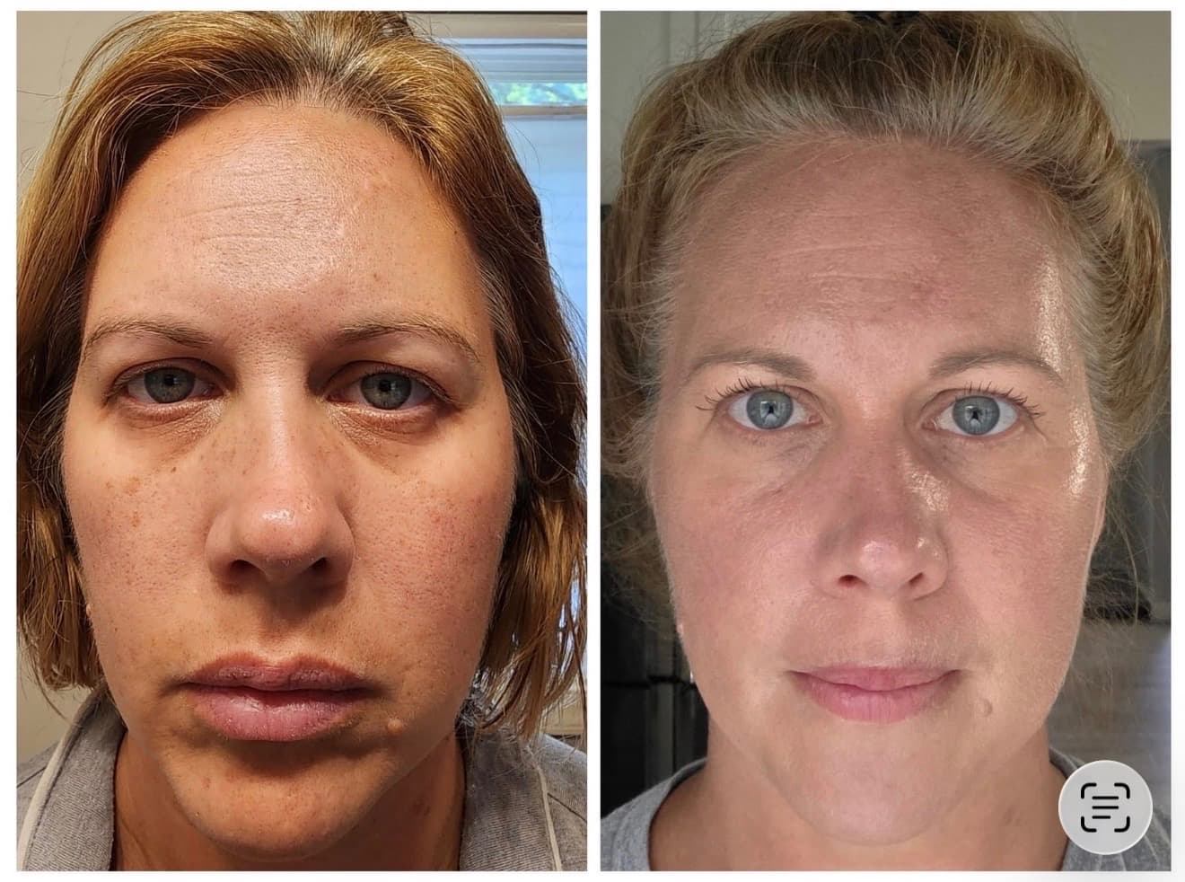Before and after result 13 — Liquid BioCell user